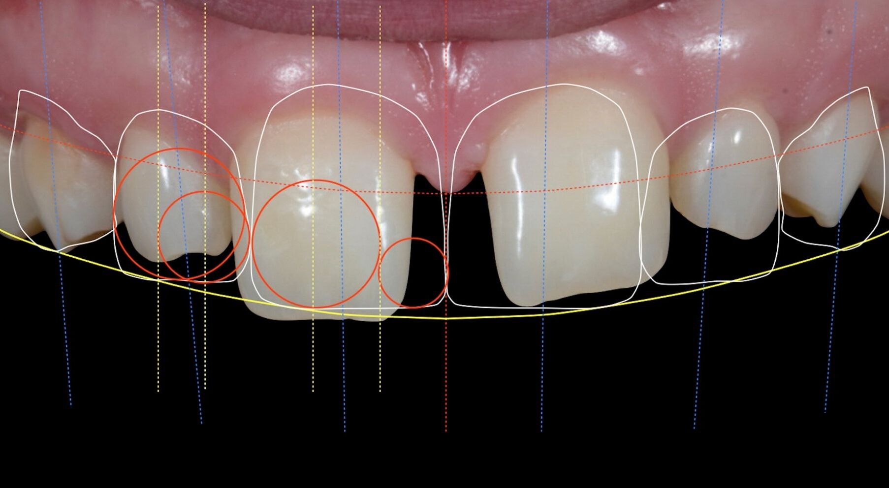 Digitale Analyse der Frontzähne mit Linien und Markierungen zur ästhetischen Planung im Rahmen eines Digital Smile Designs (DSD)